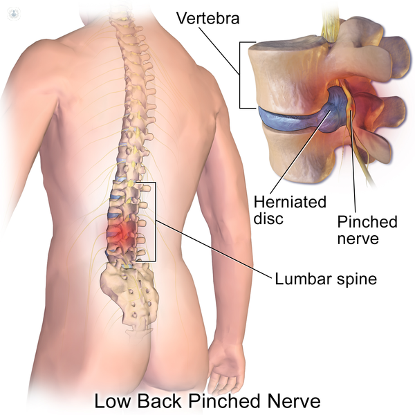 Slipped disc - The Back Dr Chiropractic Shellharbour